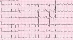 12-lead EKG of a patient presenting with palpitations, shortness of breath, and dizziness.